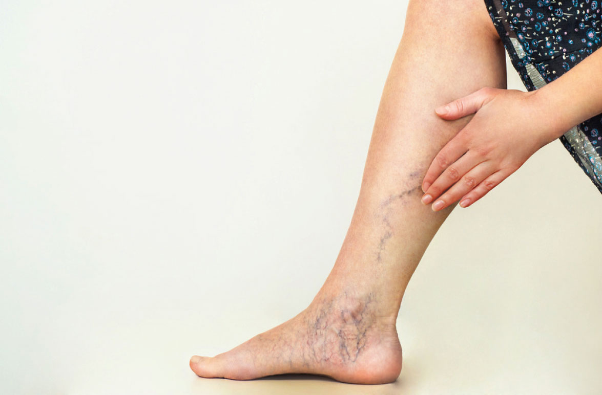 Sclerotherapy